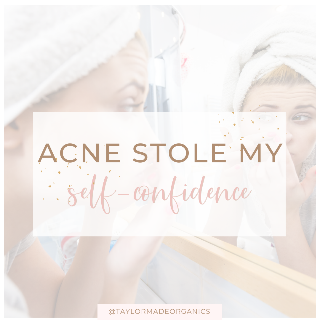 Acne stole my self-confidence | Taylor Made Organics